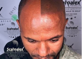 Scalp Micropigmentation the myth, the fact | an interview with Scalpalex