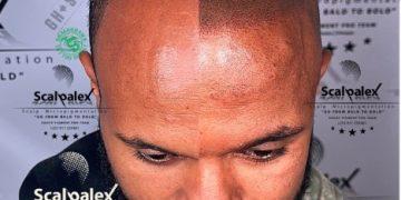 Scalp Micropigmentation the myth, the fact | an interview with Scalpalex