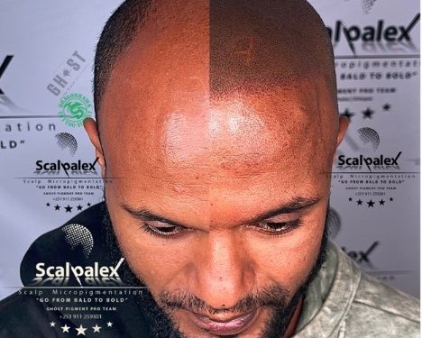 Scalp Micropigmentation the myth, the fact | an interview with Scalpalex