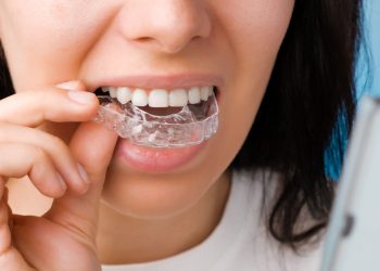 The Clear Way to a Brilliant Smile: ParisAline Aligners Break New Ground in Orthodontics