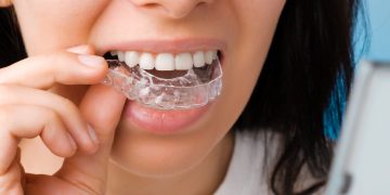 The Clear Way to a Brilliant Smile: ParisAline Aligners Break New Ground in Orthodontics